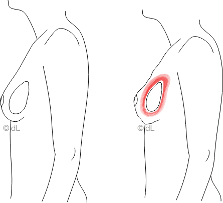@dL breast lateral capsular contracture neue Brustwarze 1